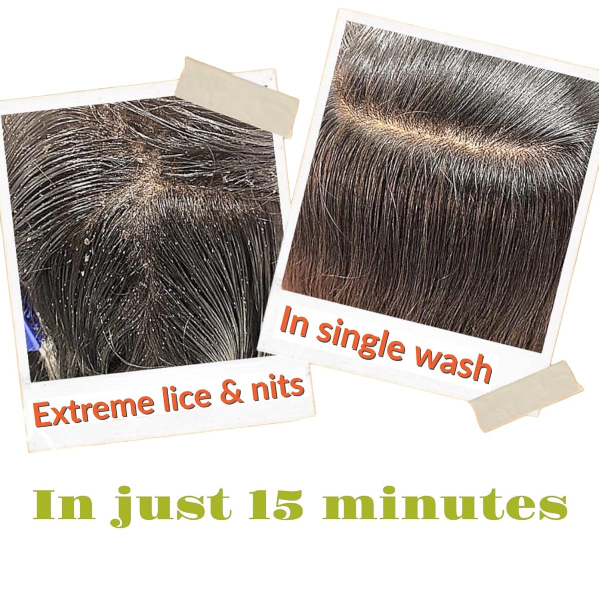 Botanical Luxuriate Tea Tree 100% Natural Anti Lice and Nits Shampoo 100ml Free Quality Transparent Lice Removal Comb With Tea Tree and Neem Extracts - Image 4